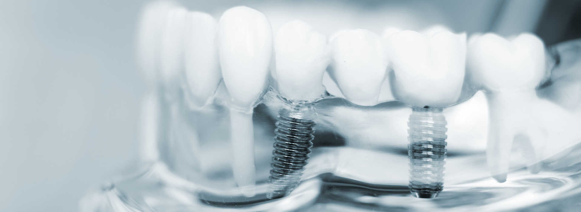 The image shows a close-up of dental implants with screws visible against a blurred background, which appears to be a medical setting.