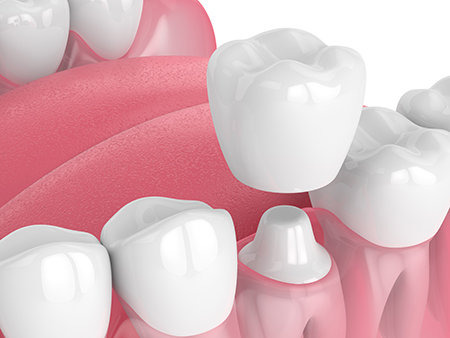 The image shows a close-up of multiple rows of artificial teeth with varying shades of pink and white, set against a plain background.