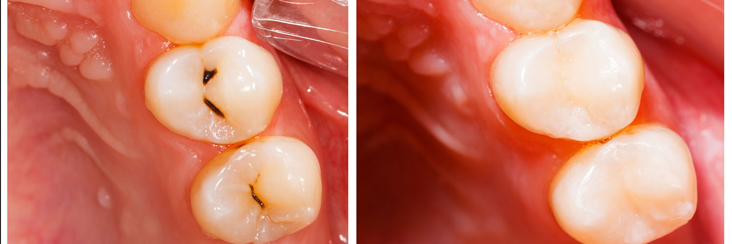 The image shows a close-up view of a person s teeth with some missing and others showing signs of decay, set against a backdrop of a mouth and tongue.