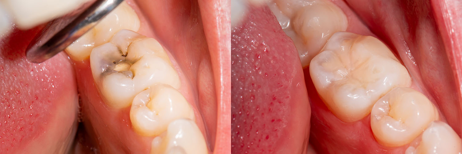 The image shows a close-up view of a person s teeth being cleaned with a dental tool, highlighting the process of oral hygiene.