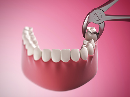 The image shows a pair of scissors with a pink handle being used to remove a tooth from a dental implant, which has multiple artificial teeth attached to it.